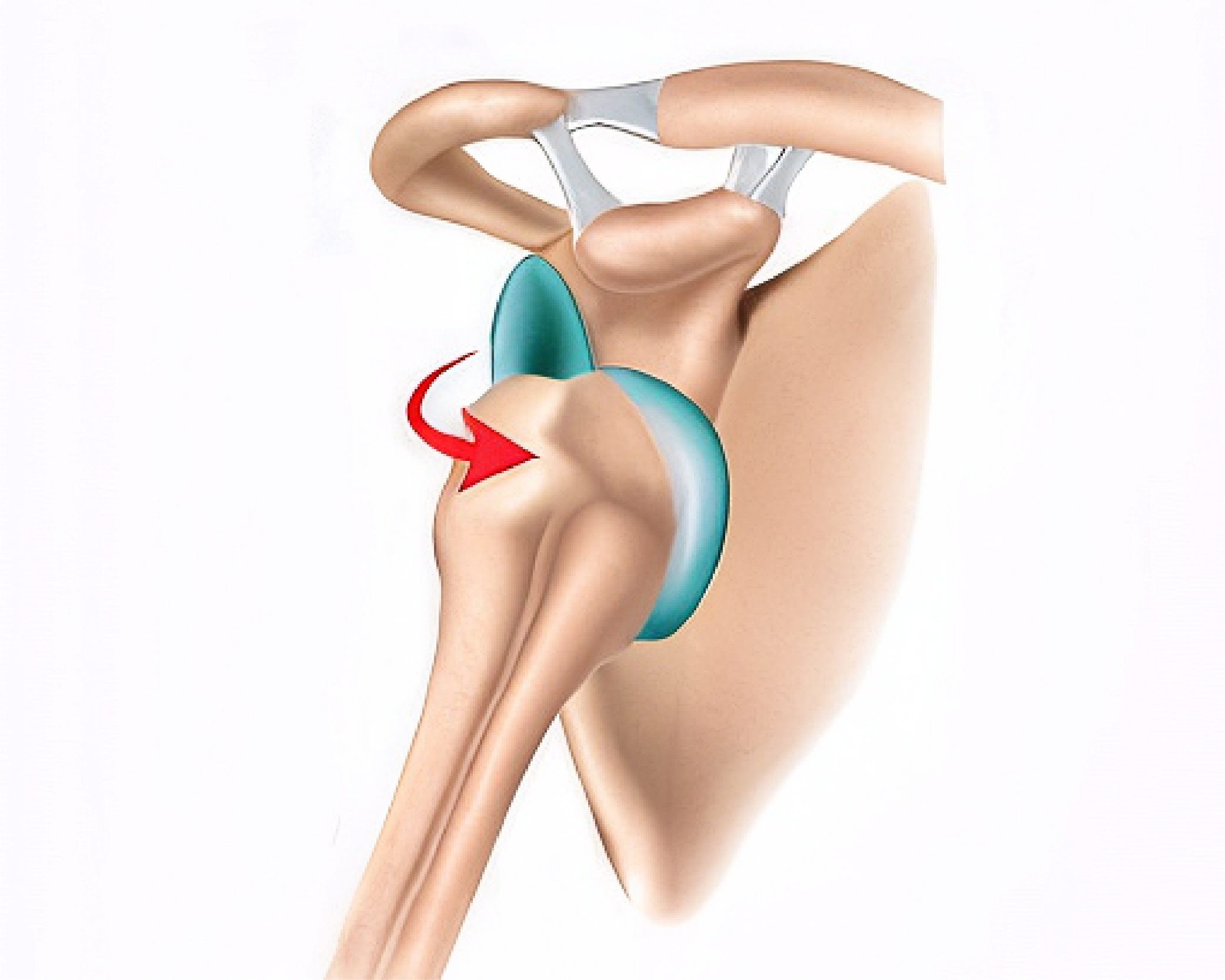 Inestabilidad glenohumeral