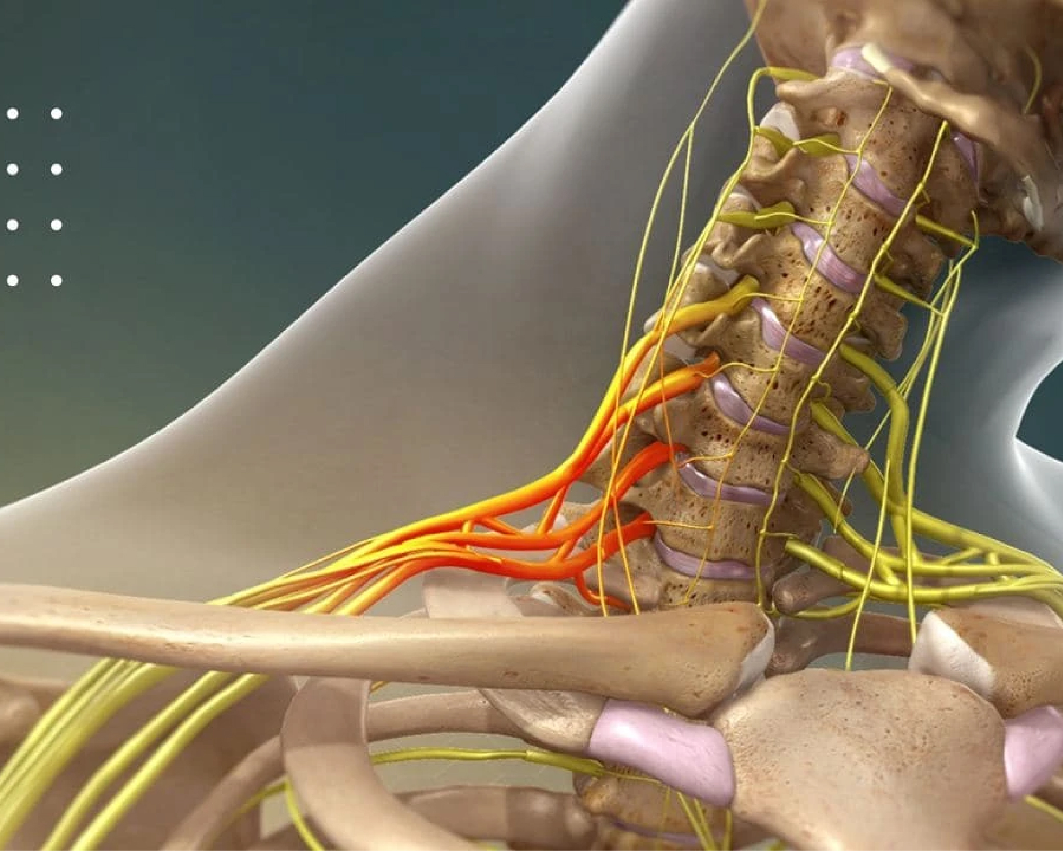 Lesión de plexo braquial
