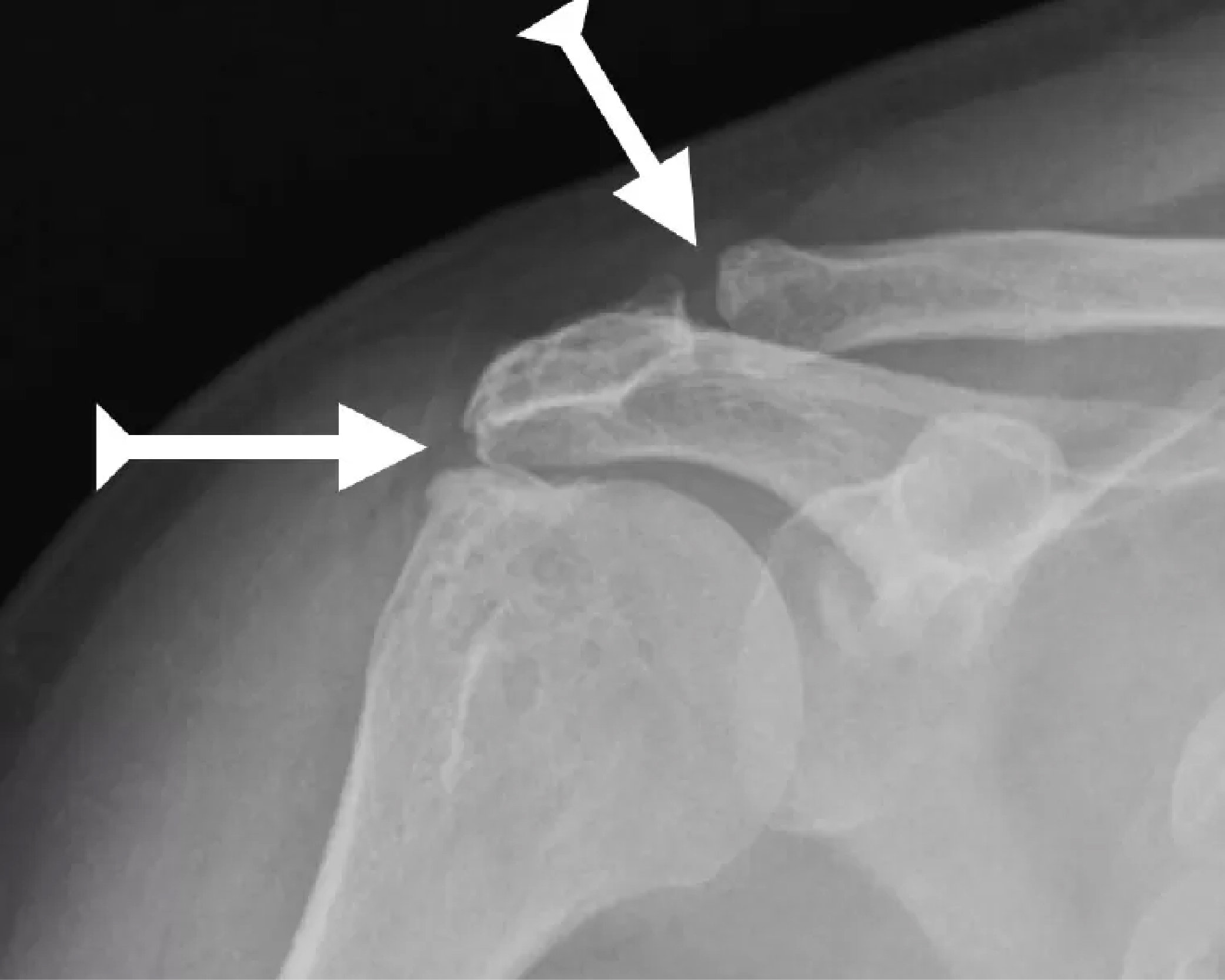 Síndrome de pinzamiento del hombro