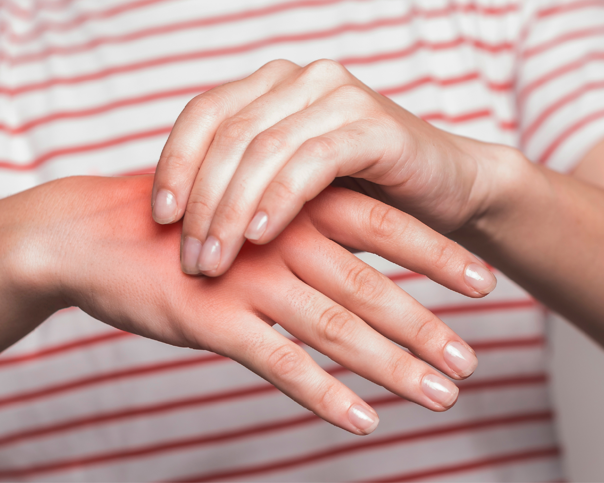 Síndrome del túnel carpiano